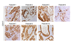靶向鈣黏蛋白17(Cadherin-17/CDH17)的CAR-T細(xì)胞系統(tǒng)性遞送策略:安全有效治療結(jié)直腸癌肝轉(zhuǎn)移的新突破 靶向鈣黏蛋白17(Cadherin-17/CDH17)的CAR-T細(xì)胞系統(tǒng)性遞送策略:安全有效治療結(jié)直腸癌肝轉(zhuǎn)移的新突破